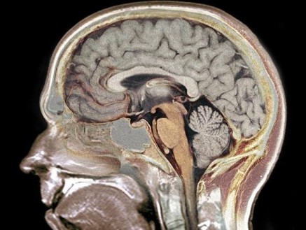 O estudo indica que pacientes com depressão, quando apresentam manifestações psicóticas, têm alteração em estruturas cerebrais